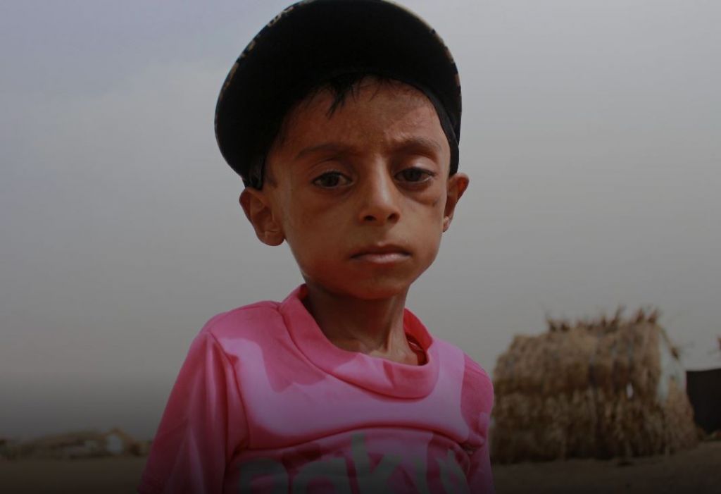 Υεμένη : Η πείνα στοιχειώνει τα παιδιά της χώρας - Η συγκλονιστική ιστορία του 10χρονου Χάσαν