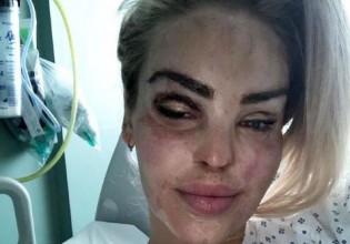 Κέιτι Πάιπερ – Η ιστορία του μοντέλου από την Αγγλία που πριν από 13 χρόνια δέχθηκε επίθεση με οξύ στο πρόσωπο