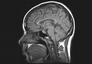 Κοροναϊός – Μελέτη βλέπει εγκεφαλικές βλάβες στο 1% των ασθενών που χρειάζονται νοσηλεία