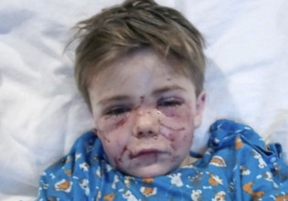 Τέξας: 7χρονο αγοράκι δέχτηκε άγρια επίθεση από σκύλο