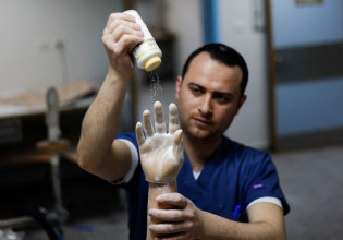Βιονική χείρα βοηθείας στους ακρωτηριασμένους Παλαιστινίους