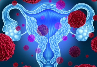 Καρκίνος των ωοθηκών: Όλα όσα θέλετε να γνωρίζετε για τον πιο θανατηφόρο γυναικολογικό καρκίνο