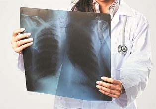 Πρόληψη για τον καρκίνο του πνεύμονα