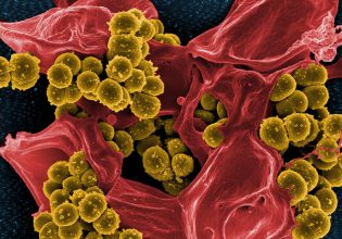 Καρκίνος: Πληθαίνουν οι ενδείξεις για εμπλοκή μικροβίων στο σχηματισμό όγκων και τη μετάσταση