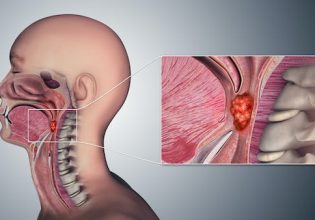 Ενοχοποιείται το στοματικό σεξ για καρκίνο του φάρυγγα; Τι λέει βρετανός ειδικός