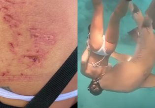 Μαλδίβες: Στιγμές τρόμου για κολυμβήτρια – Τη δάγκωσε καρχαρίας 100 κιλών