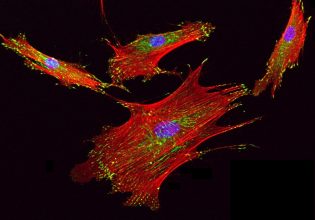 Βλαστικά κύτταρα «εξαφάνισαν» τις επιληπτικές κρίσεις σε δύο ασθενείς