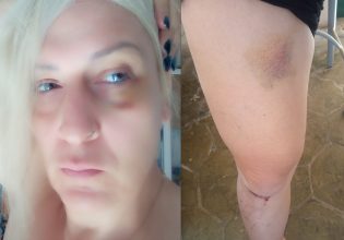 Άγρια τρανσφοβική επίθεση στο κέντρο της Αθήνας – «14 άτομα με χτυπούσαν με λύσσα»