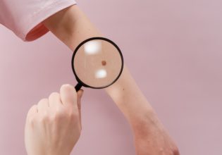 Οι μισοί και πλέον καρκίνοι δέρματος μπορούν να προληφθούν