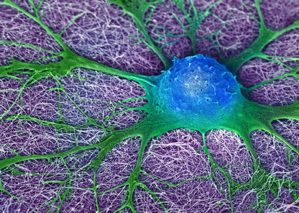 Πολλαπλή σκλήρυνση: Βλαστικά κύτταρα σταμάτησαν την εξέλιξη της νόσου