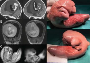 Τα 10 παράξενα ιατρικά περιστατικά του 2023 – Από «γούνινη» γλώσσα μέχρι… έμβρυο στον εγκεφάλο μωρού