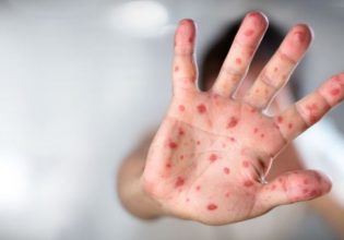 ΕΟΔΥ: Τρεις επιδημίες ιλαράς στην Ελλάδα, με 4.151 κρούσματα και 4 θανάτους