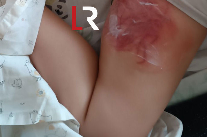 Φθιώτιδα: Θαλάσσια ανεμώνη τσίμπησε 4χρονη προκαλώντας της σοβαρά εγκαύματα