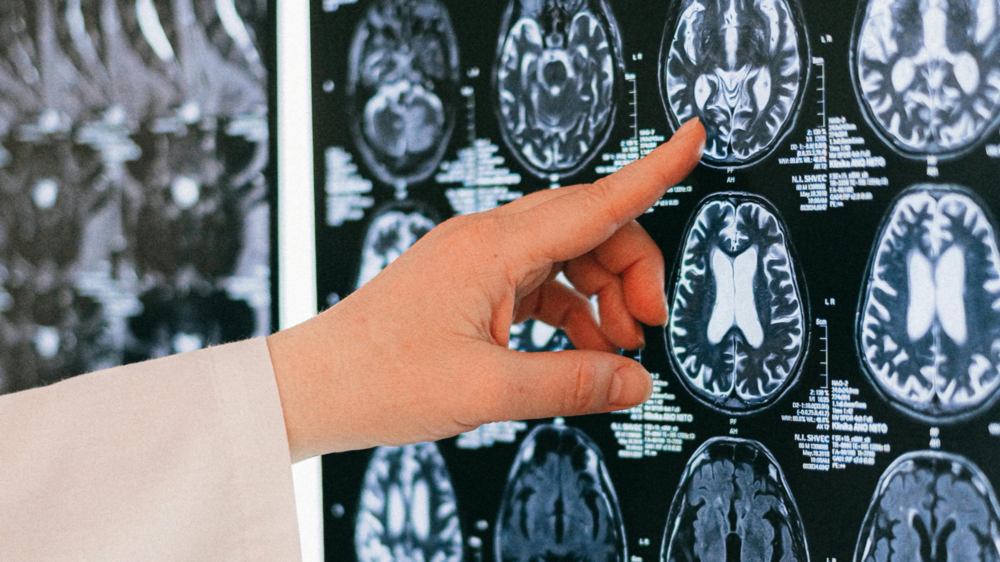 Καναδάς: Ανησυχία για μυστηριώδη ασθένεια του εγκεφάλου - Επιστήμονες καταγγέλλουν απαγόρευση μελέτης