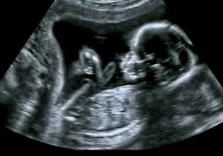 Μεταμόσχευση ωοθηκών: Πρώτη γέννηση στην Ελλάδα με τη νέα τεχνική