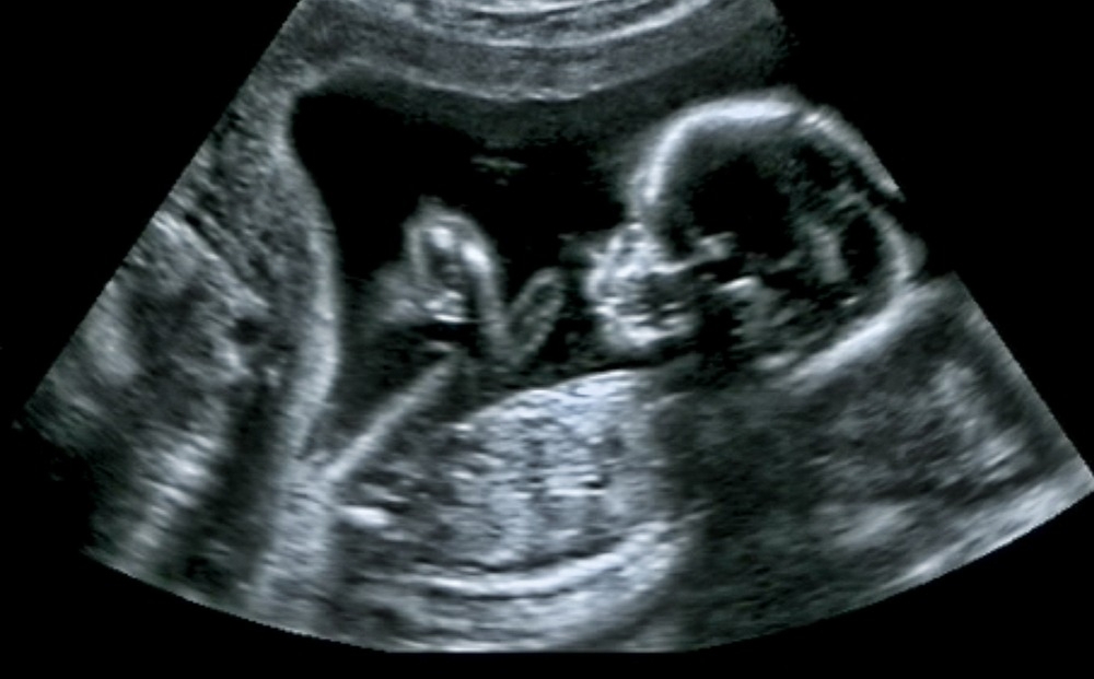 Μεταμόσχευση ωοθηκών: Πρώτη γέννηση στην Ελλάδα με τη νέα τεχνική