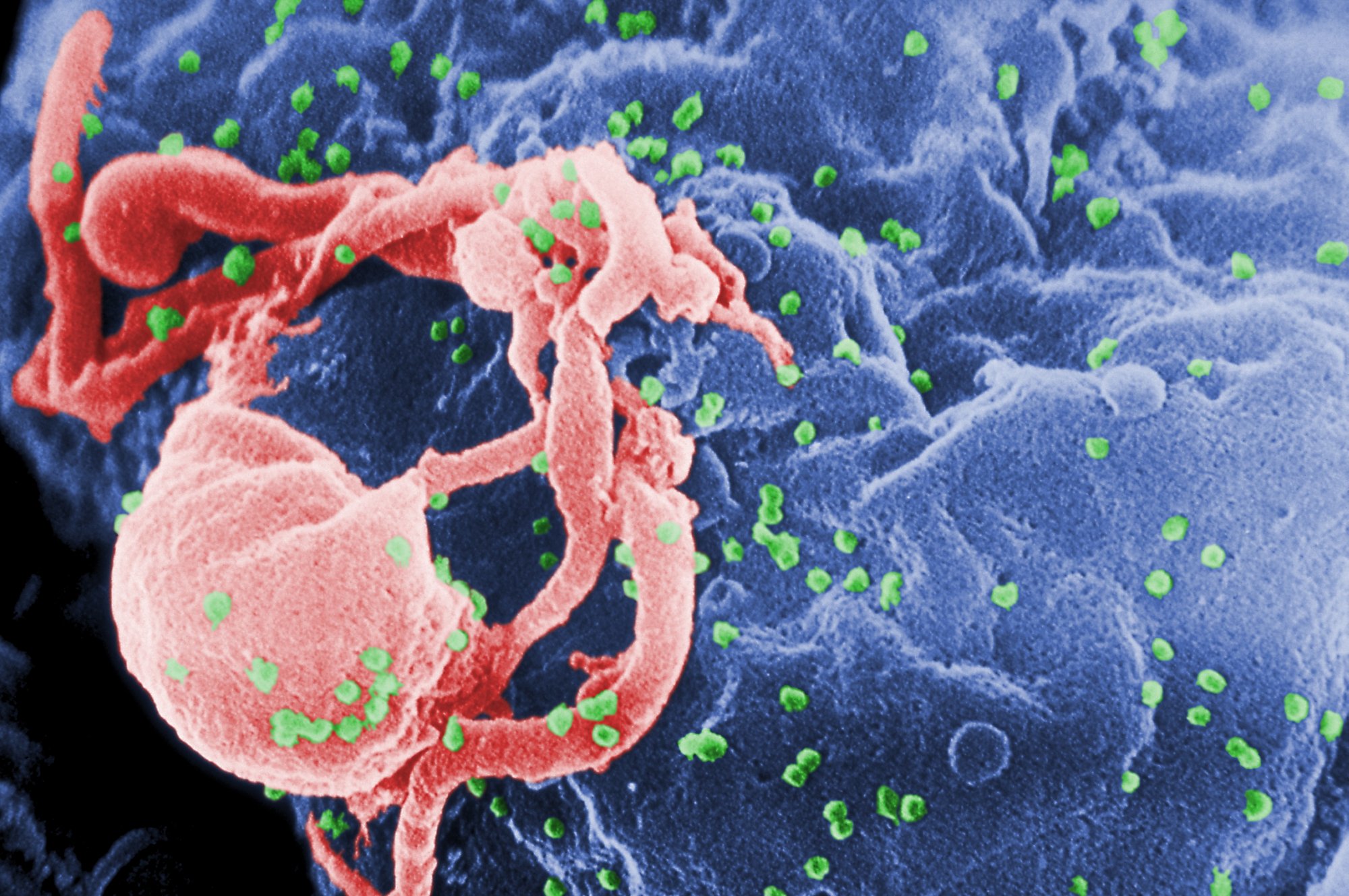 HIV: Έβδομη περίπτωση ασθενή που δείχνει να θεραπεύτηκε πλήρως