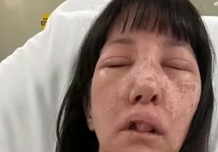Γεωργία: Γυναίκα δέχθηκε επίθεση από δηλητηριώδεις αράχνες και παραμορφώθηκε το πρόσωπό της