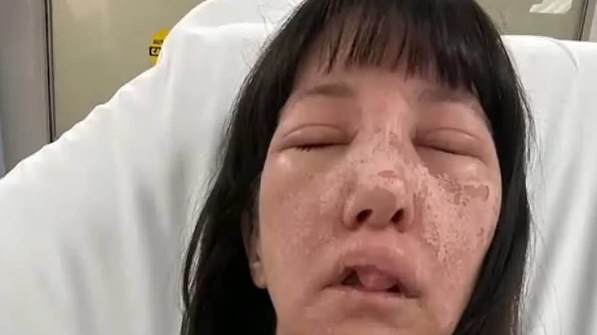 Γεωργία: Γυναίκα δέχθηκε επίθεση από δηλητηριώδεις αράχνες και παραμορφώθηκε το πρόσωπό της